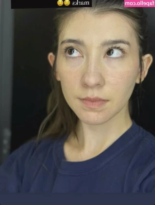 Kaisa - the tan lines and irritated skin have started