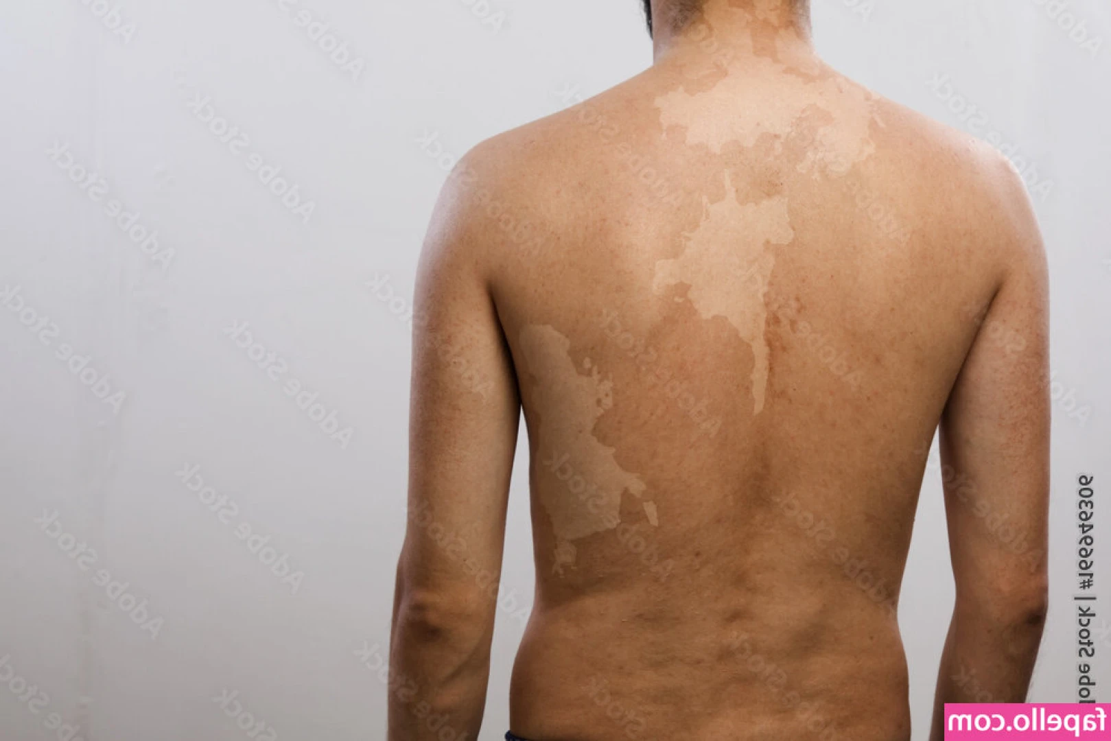 Vitiligo - Can I get you something to drink, or have you decided what you want?