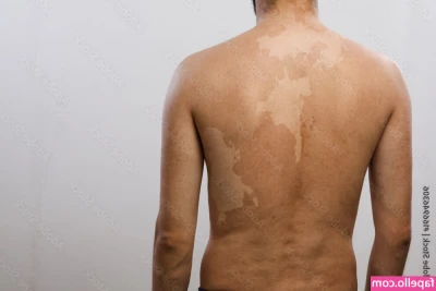 Vitiligo - Can I get you something to drink, or have you decided what you want?