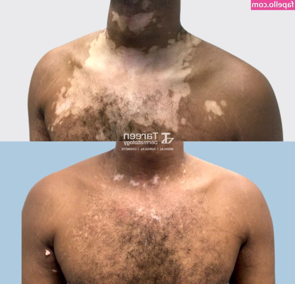 Vitiligo - I was bored at my parents house