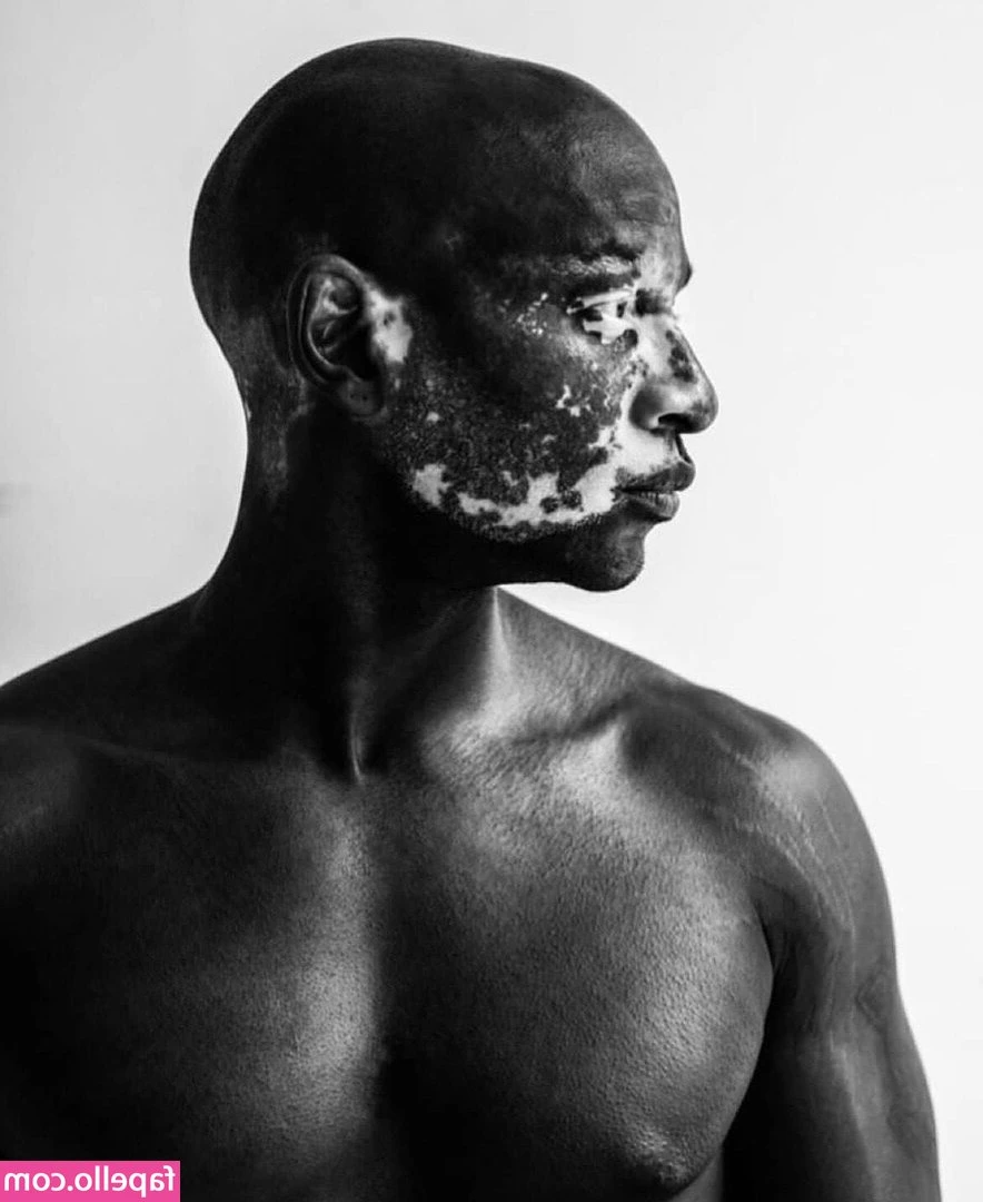 Vitiligo - i wanna your attention💋💋💋
