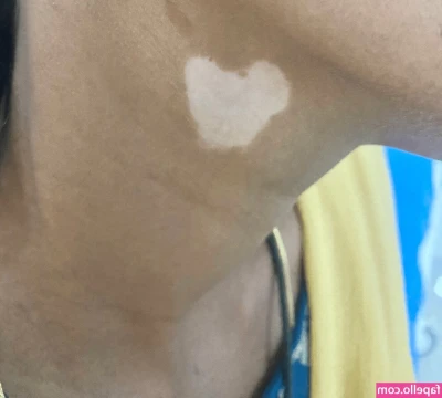 Vitiligo - Ive always enjoyed my titties swelling. It’s very interesting to